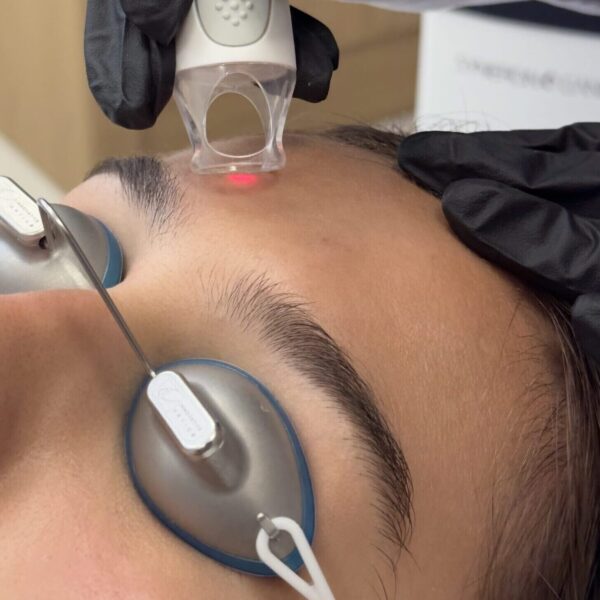 Лазерно Подмладяване