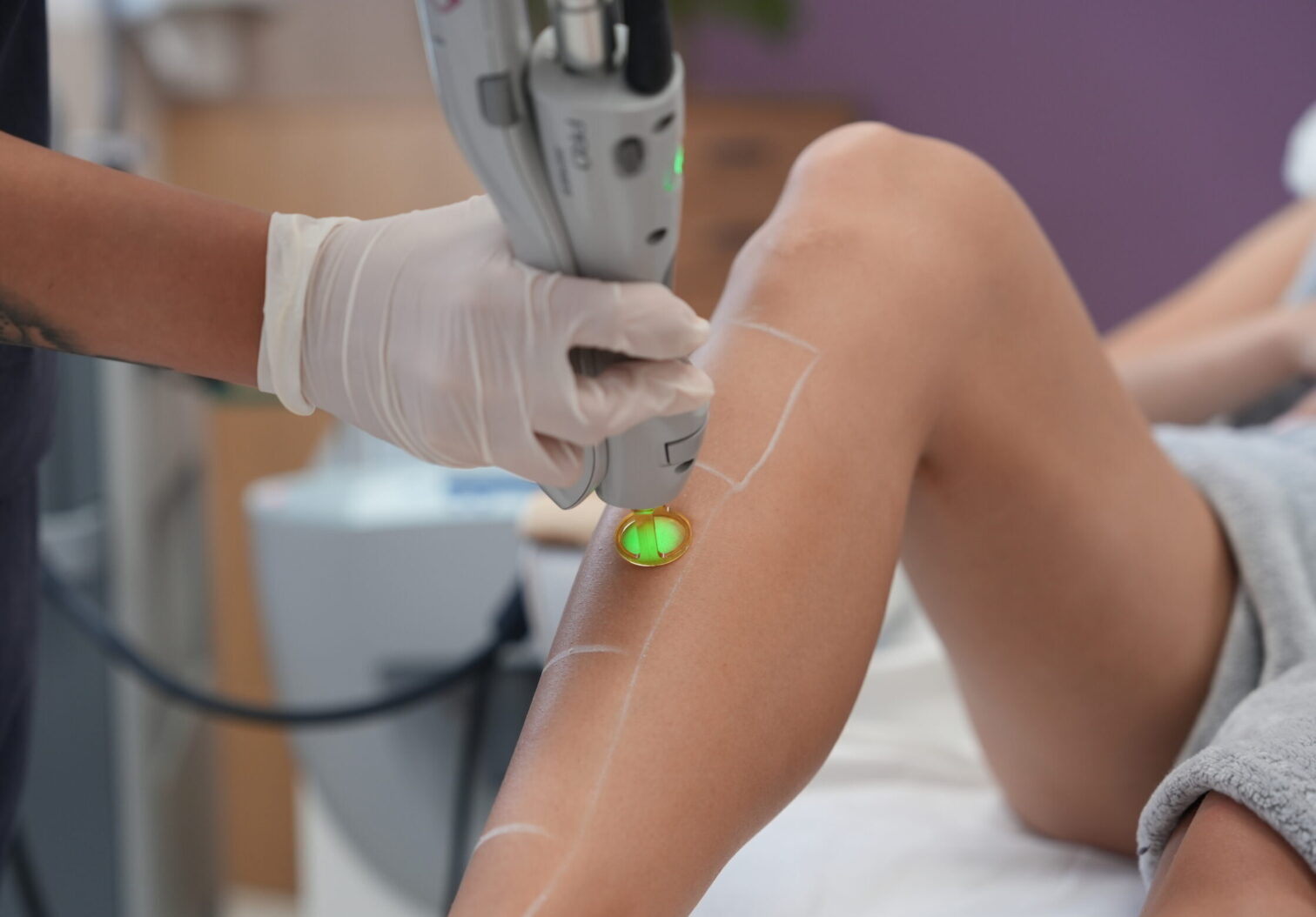 александритна лазерна епилация крака