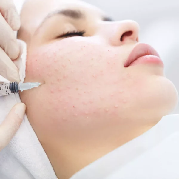 Мезотерапия